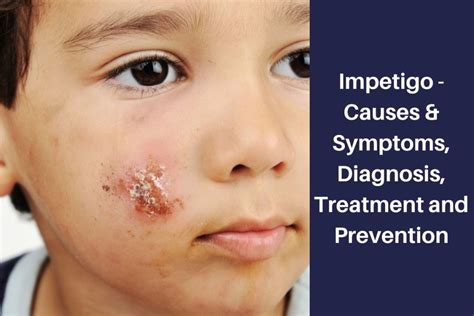 Impetigo: Symptoms, Causes, Complications, and Treatments.